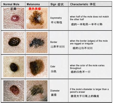 新的痣|痣也可能会癌变！长在 3 个地方要注意